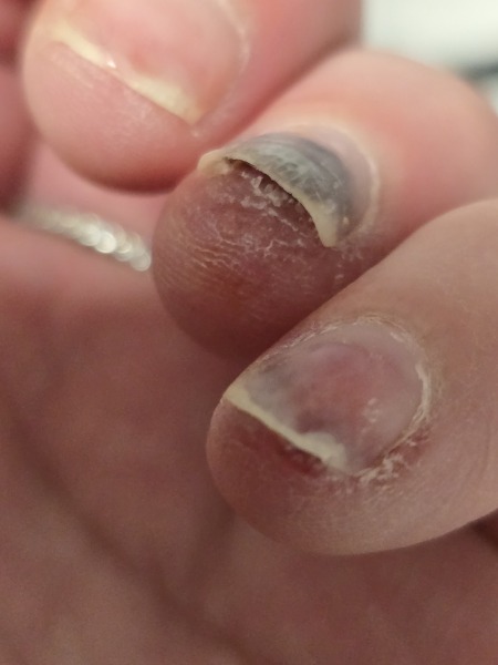 Nail damage