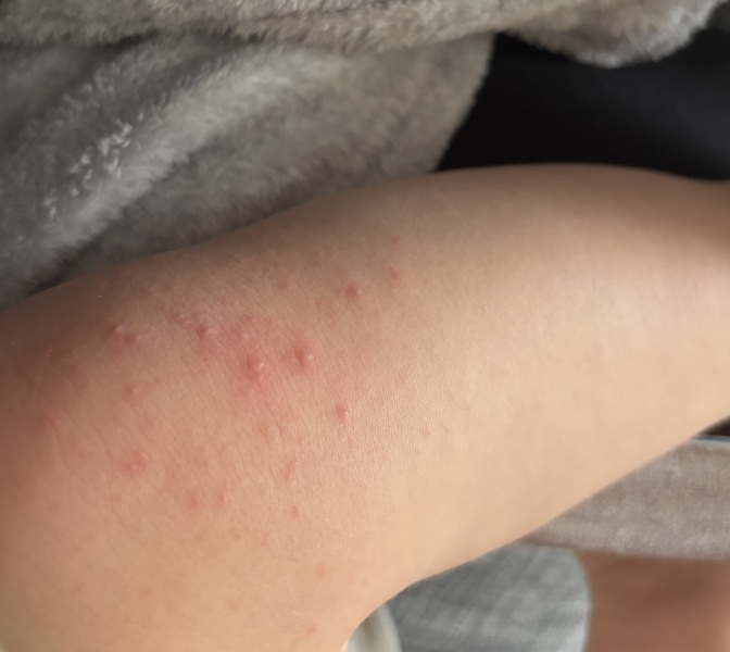 Scarlet Fever?