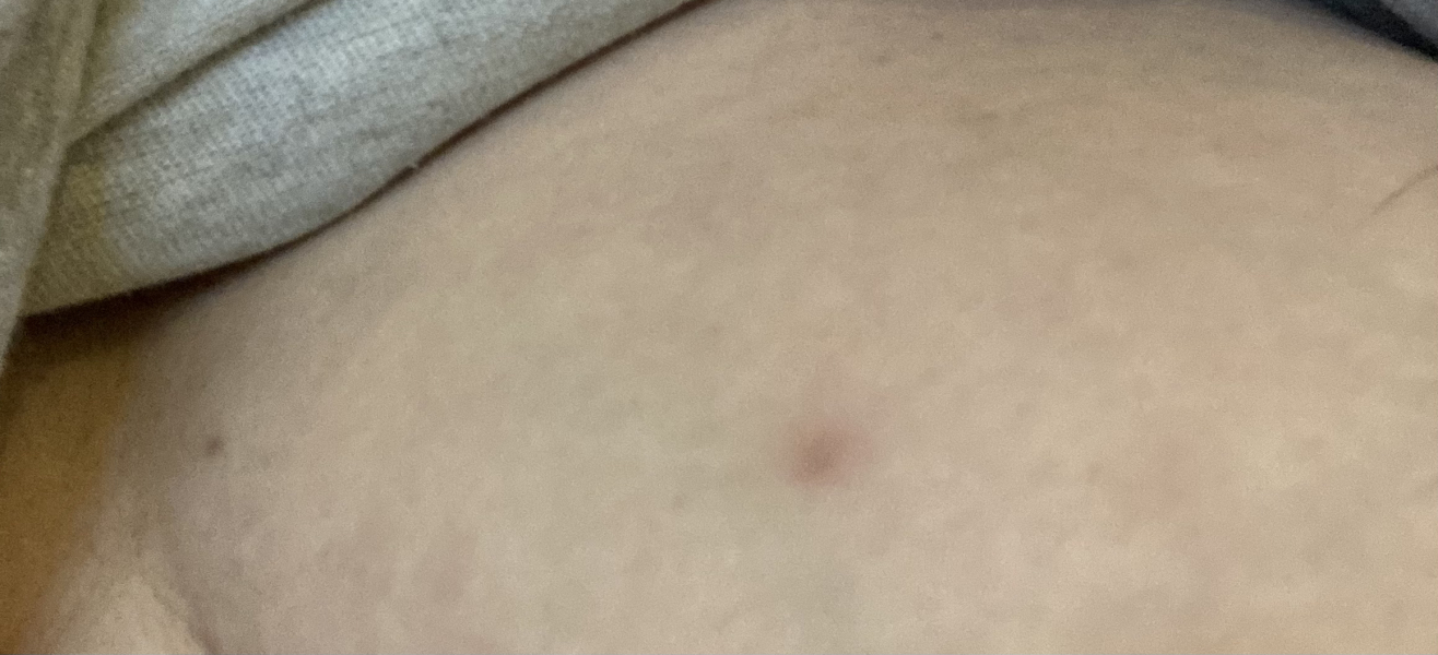 What is this bruise (pic attached)