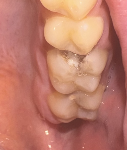 Disgusting pic warning.. but what has happened to my tooth?!