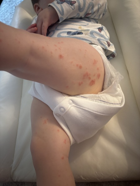 Rash on baby - allergy?
