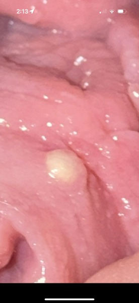 White/Yellow bump inside tissue of vagina under urethra