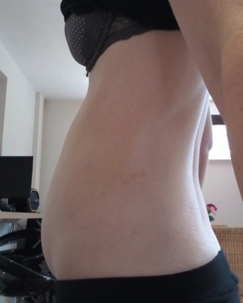 Disproportionate stomach