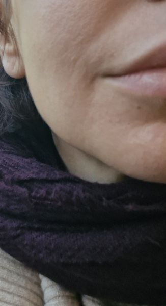 To ask about these lines around my mouth? Mid 30s