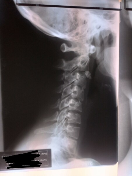 What's this on my x-ray?