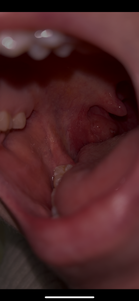 White spots on tonsils