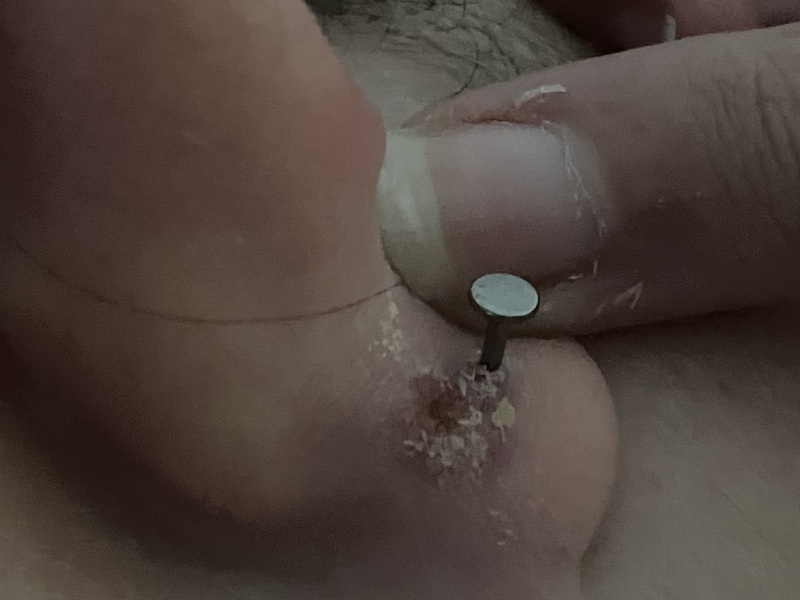 Weird crusty lump next to piercing! (Photo attached)