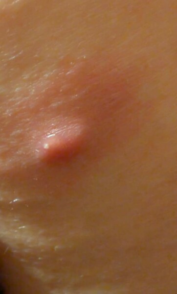 Klaxon.....massive boil on bum! TW:pic included!