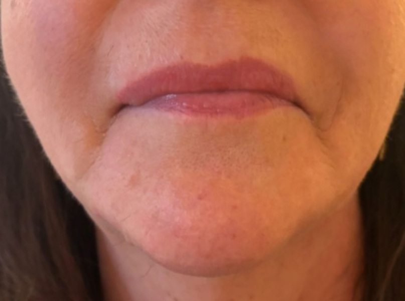 Botox or fillers? Help please