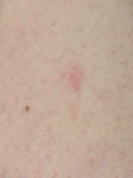 Vaccination is this unusual