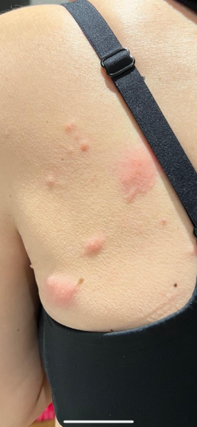 Shingles??
