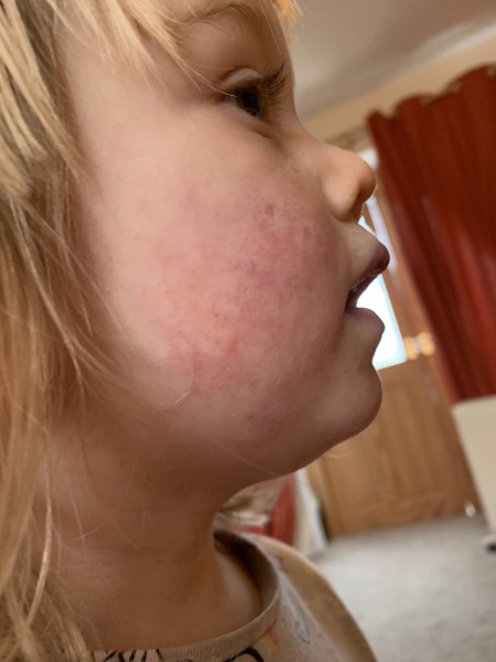 Cutis marmorata on baby’s face 