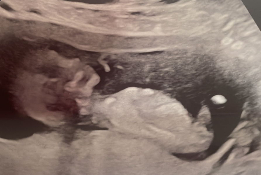 Boy or girl? Nub theory