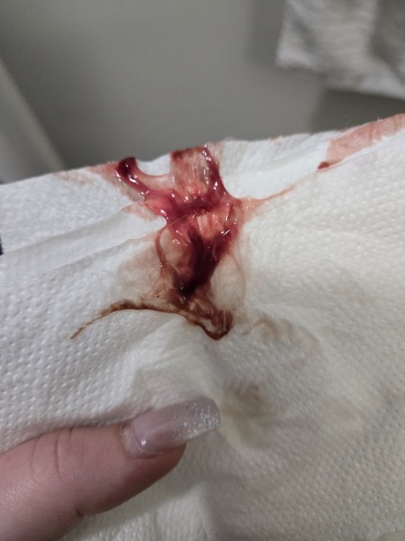 Is this mucus plug or bloody show? Sorry for graphic pic
