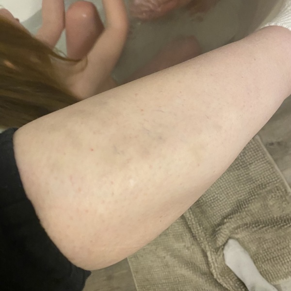 Unexplained bruising - blood test all clear