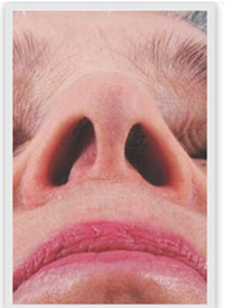 Why is my nose subtly starting to look deformed??
