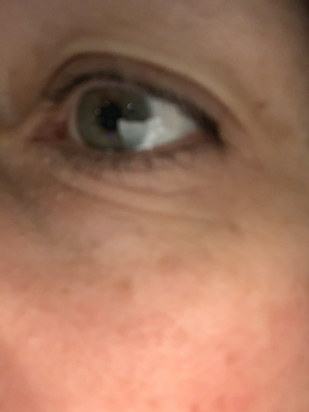 Wrinkly skin under one eye help me!