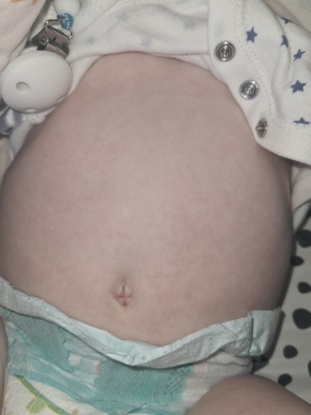 Rash on 10 month old