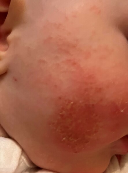 Eczema - We think