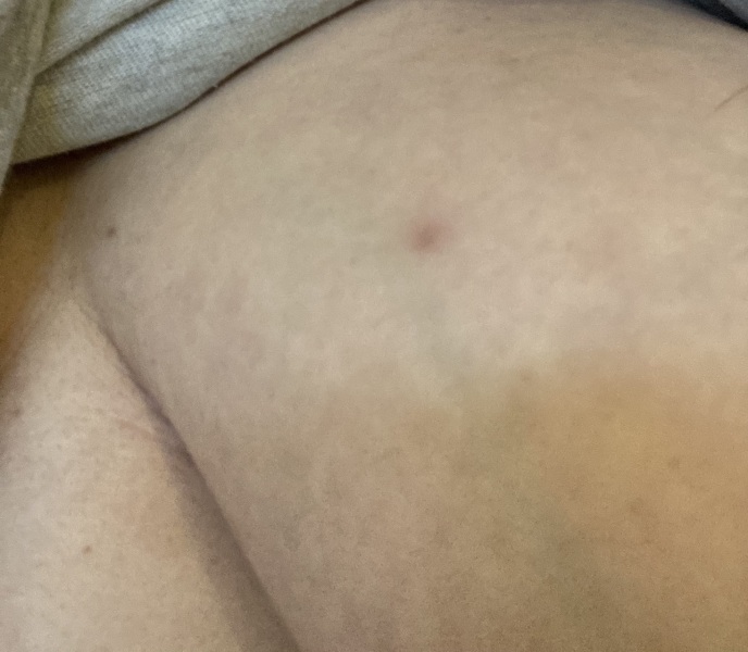 What is this bruise (pic attached)
