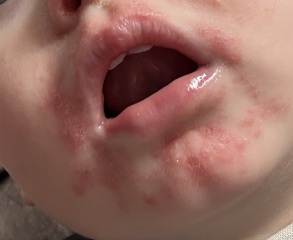 Rash/blisters on 17 month old *pics*