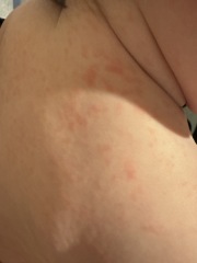 MMR After Injections