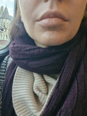 To ask about these lines around my mouth? Mid 30s