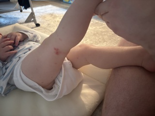 Rash on baby - allergy?