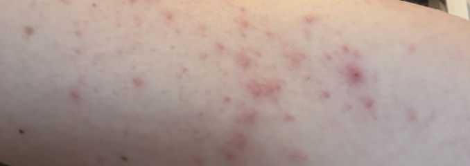 Very itchy spots - bother gp?