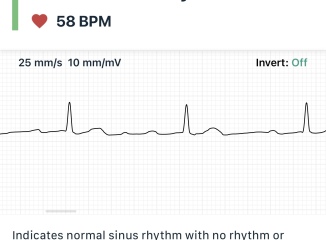 Any DRs/nurses? ECG question?