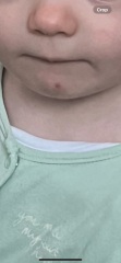 Toddler same spot on face for 8 weeks