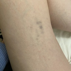 Unexplained bruising - blood test all clear