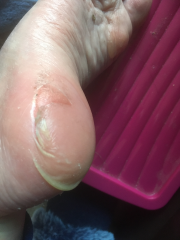 Really sore blisters anyone got anything that works other than compeed?