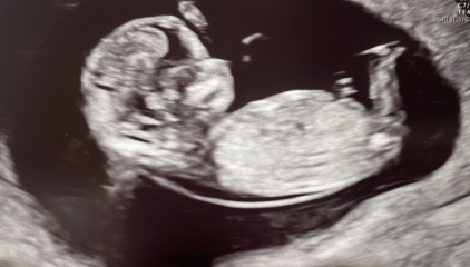 12 week scan - ultrasound experts needed please, is this normal?