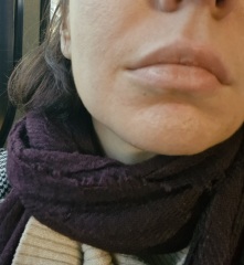 To ask about these lines around my mouth? Mid 30s