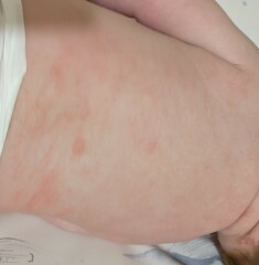 Baby eczema? Photos attached