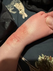 Rash/blisters on 17 month old *pics*