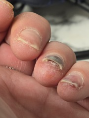 Nail damage