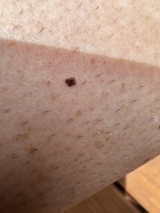 Does this look like melanoma