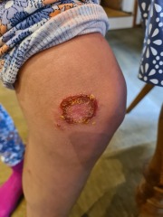 Hand infected (Warning, gross photos)