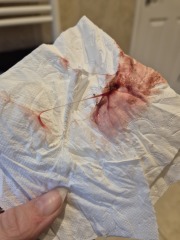 Is this is miscarriage or common discharge? Any help appreciated