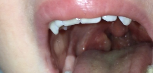 Daughter’s throat- opinions please