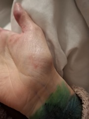 Contact Dermatitis? Please help!
