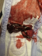 Failed Abortion- Continued pregnancy after finding out..