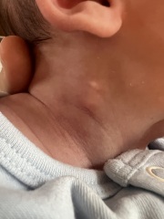 Lumps on babies neck