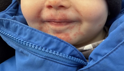 Rash/blisters on 17 month old *pics*
