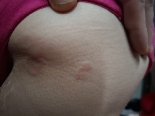 Hand infected (Warning, gross photos)