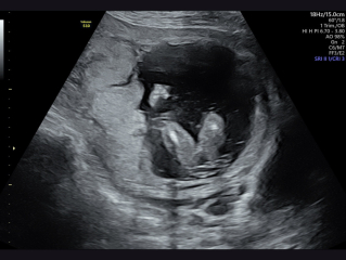 17 week private ultrasound
