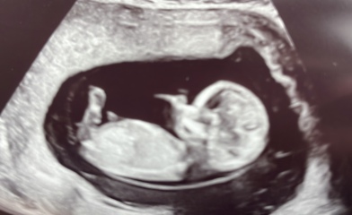 12 week scan - ultrasound experts needed please, is this normal?