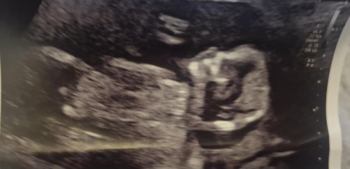 Nub theory 13 weeks then 20 weeks